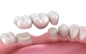 Infographic of a dental bridge going over a missing tooth