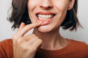 Close up of woman’s smile as she pulls down her lip to show her gums with gum disease