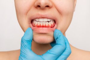 Close-up shot of gum with gingivitis